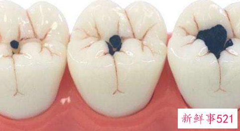 蛀牙的修补方法有哪些