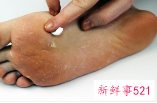 脚底脱皮什么原因