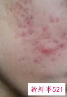 脸为什么总长痘痘