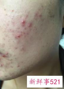 脸为什么总长痘痘