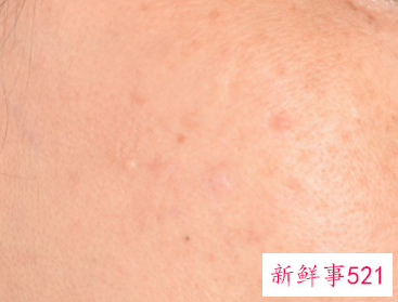 一张脸都是痘痘