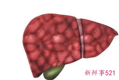 肝硬化病的饮食和禁忌