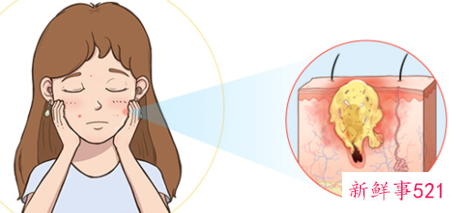 油性皮肤怎么去痘痘方法