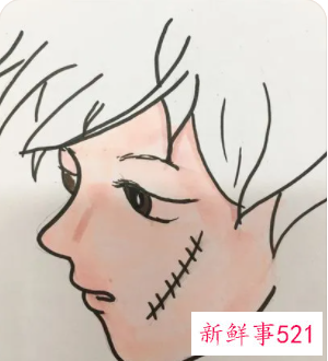 脸被指甲划伤怎么处理不会留疤