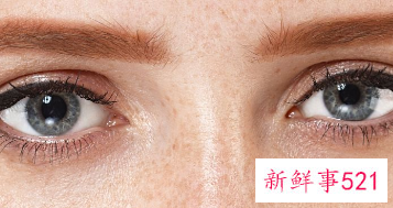 割双眼皮什么年龄最合适