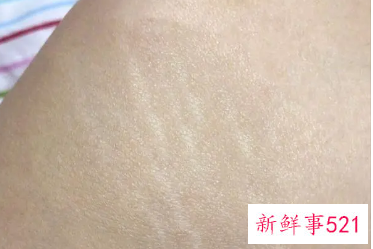 长肥胖纹的原因是什么