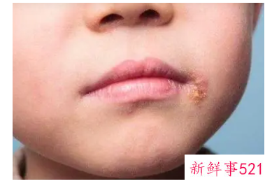 嘴角两侧皮肤干燥起皮