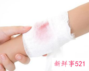 伤口被晒会色素沉着吗