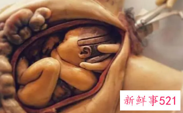 孩子顺产头部变形可会恢复