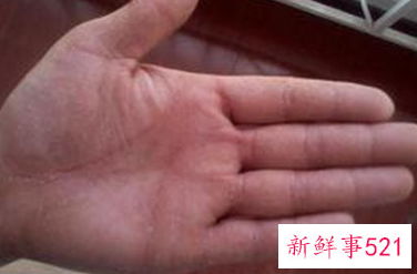 手脱皮是为什么