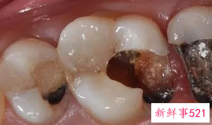 蛀牙的修补方法有哪些