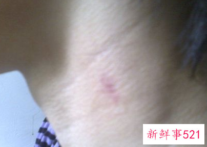 脖子上有吻痕怎么办