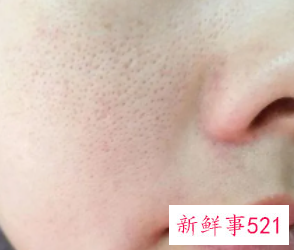 皮肤不好毛孔粗大怎么改善