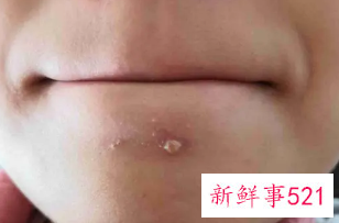 痤疮不挤里面的脓会消吗