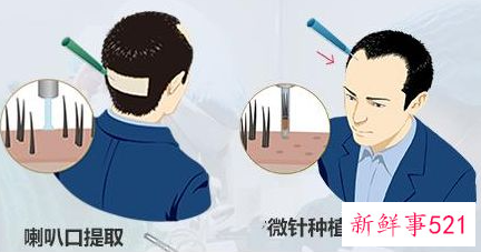 植发1000单位是要多少钱