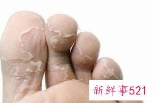 脚底脱皮什么原因