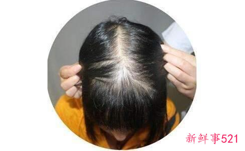 油脂分泌旺盛脱发怎么办