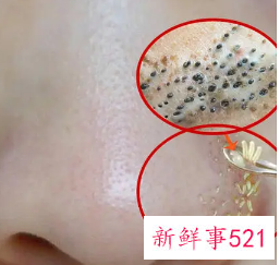 如何清理堵塞的毛孔