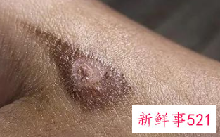 伤口被晒会色素沉着吗