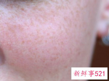 脸上脓包留下的红印会恢复吗