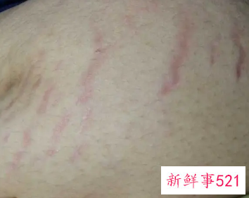 长肥胖纹的原因是什么