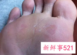 脚底脱皮什么原因