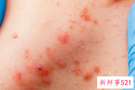 面部皮癣用什么药膏好得快