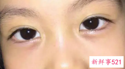 小孩眼袋重是什么原因造成的