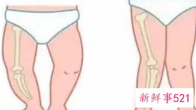 孩子突然腿无力一会又好了