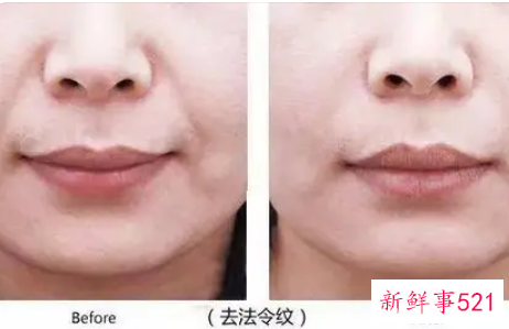 法令纹怎么形成的如何淡化