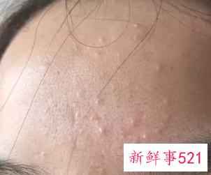 脸上有好多隐形小疙瘩咋回事
