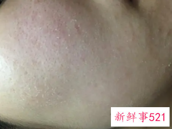 脸上很干燥起皮用什么护肤品