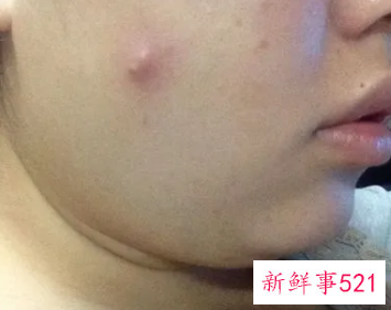 脸上脓包留下的红印会恢复吗