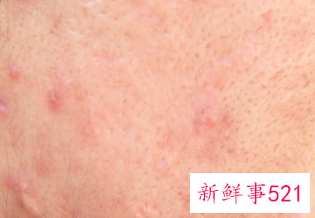 脸上有好多隐形小疙瘩咋回事
