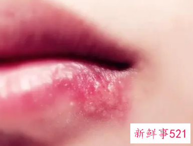 嘴角起小水泡是什么原因