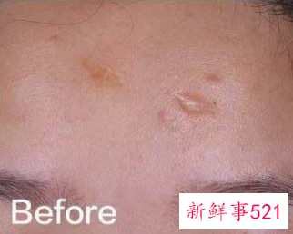 脸被指甲划伤怎么处理不会留疤