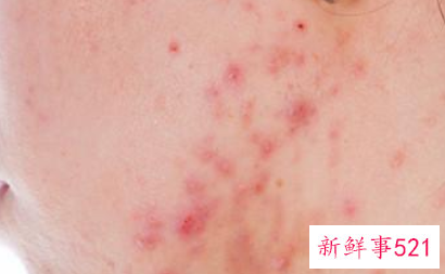 一张脸都是痘痘