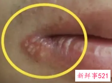 嘴角起小水泡是什么原因