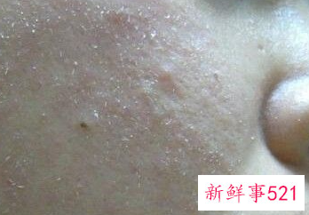 孕妇脸上长癣怎么办