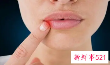 嘴唇干裂脱皮小妙招