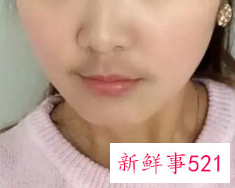 女生突然长胡子是为什么