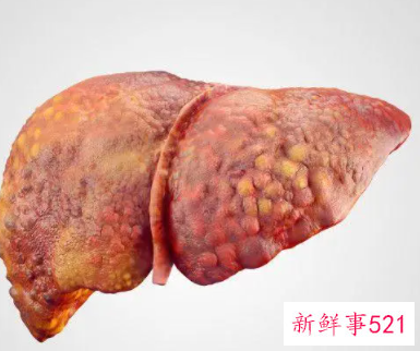 肝硬化病的饮食和禁忌