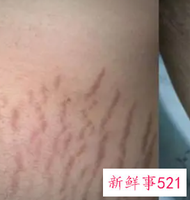 白色肥胖纹怎么形成的