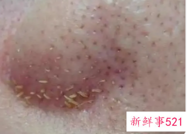 怎样才能让黑头永远消失