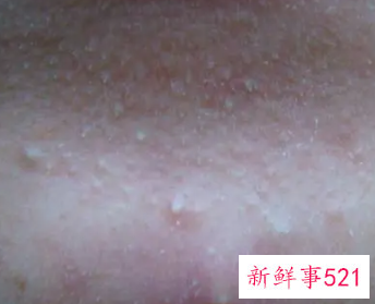 脸上起白色凸起的小米粒