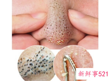 如何清理堵塞的毛孔