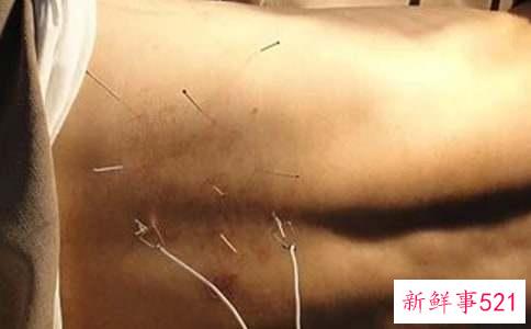 针灸减肥有哪些坏处