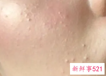 脸上起白色凸起的小米粒