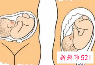 臀位一般多少周容易破羊水