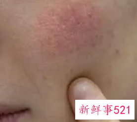 脸上干燥起皮发红紧绷怎么办